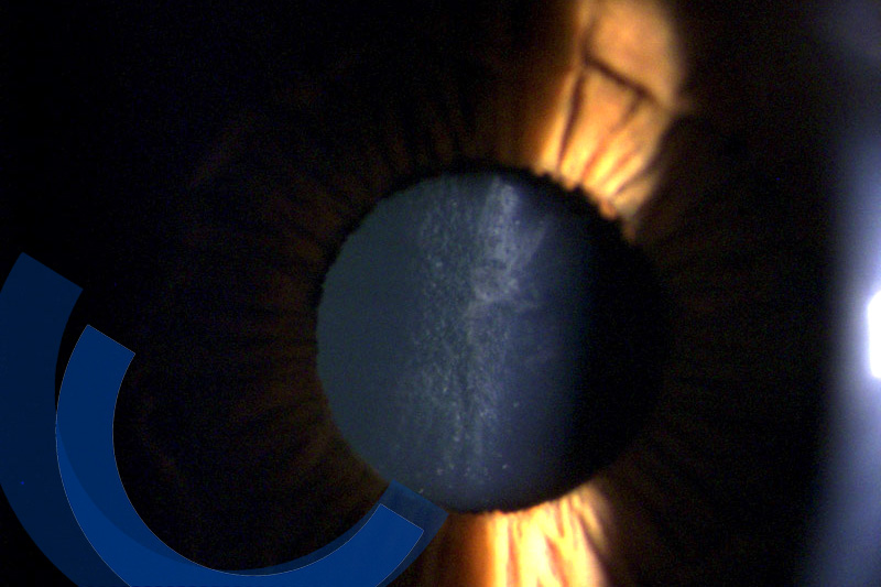 Pupille mit dahinterliegender getrübter Augenlinse